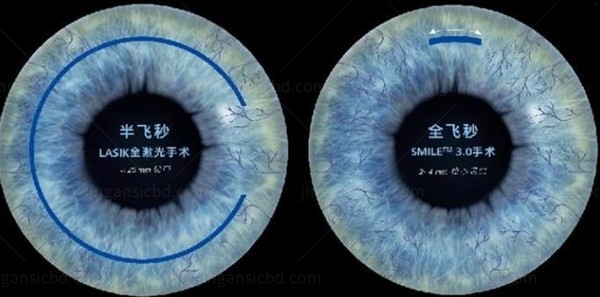 广州视百年眼科半飞秒近视眼手术：11800元