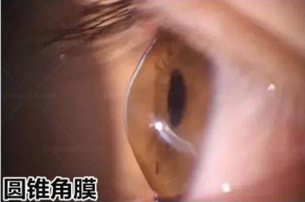 圆锥角膜能做近视眼手术吗.jpg
