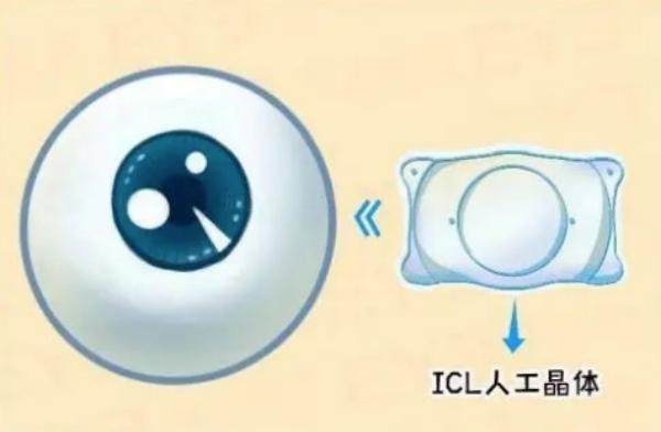 人工晶体植入能用多少年？www.jingansicbd.com