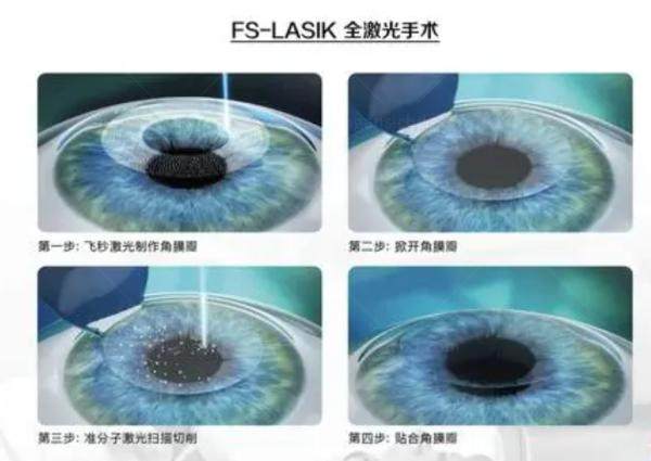 年轻人近视800度眼晴散光怎么治疗？这几种治疗方法快来看！