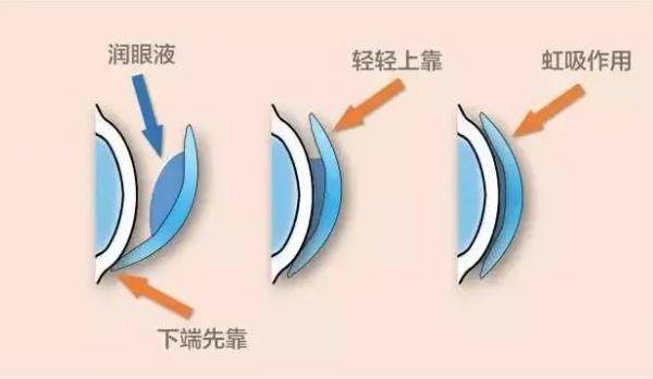 爱尔眼科ok镜价格表2023-爱尔眼科国产ok镜品牌价格公布.jpg