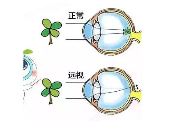 远视眼无法成像在视网膜上.jpg