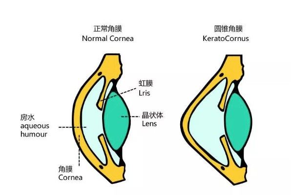 角膜结构和变形.jpg