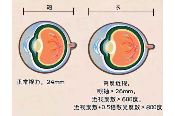 高度近视眼轴增长.jpg