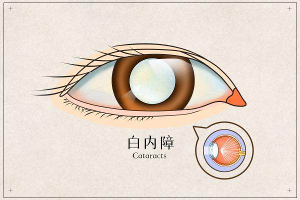 白内障1000多元的晶体咋样.jpg