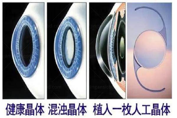 www.jingansicbd.com白内障晶体
