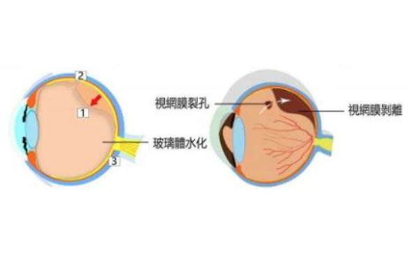 后巩膜加固术费用标准www.jingansicbd.com