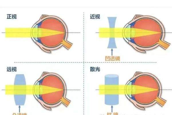 www.jingansicbd.com屈光不正和近视眼的区别是什么?屈光不正包括近视、远视和散光三种屈光状态.jpg