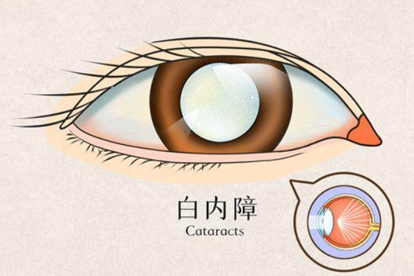 福建白内障免费政策,含白内障免费政策条件以及如何申请www.jingansicbd.com.jpg