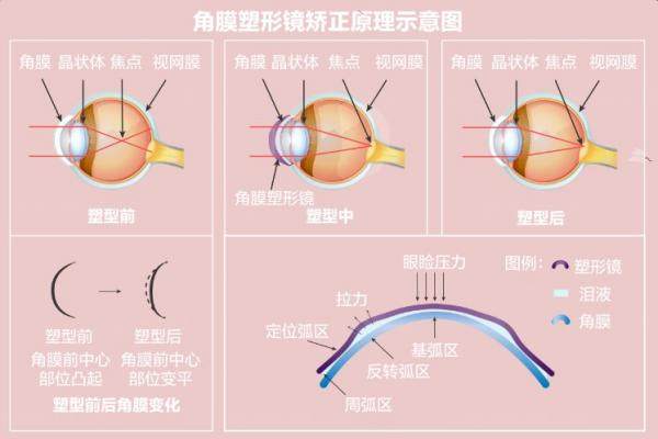 重庆爱成眼科医院配角膜塑形镜价格.jpg