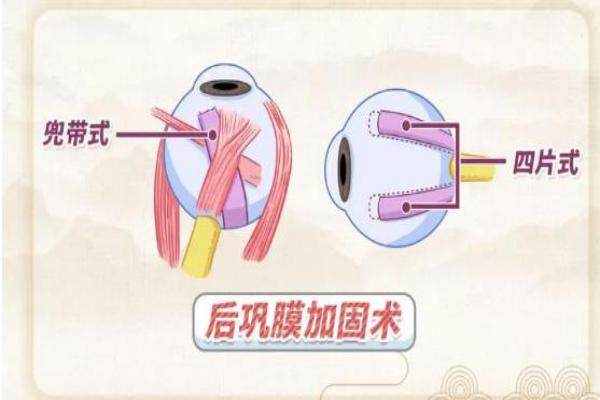 王乐今后巩膜加固术病例可以参考吗www.jingansicbd.com