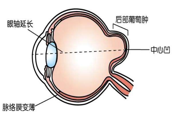 王乐今做后巩膜加固术怎样www.jingansicbd.com