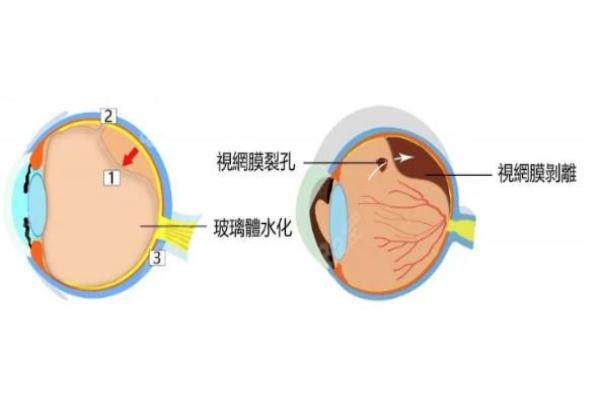 段安丽后巩膜加固术是微创吗www.jingansicbd.com