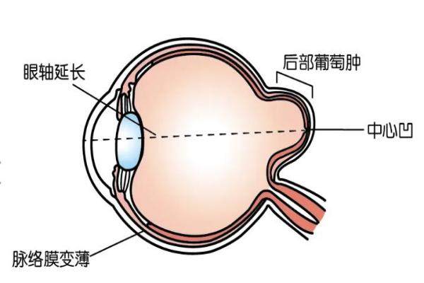 后巩膜加固术和晶体植入手术区别www.jingansicbd.com