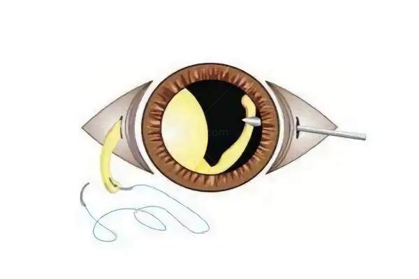 人工晶体悬吊术能撑20年吗?可以！还有注意事项介绍