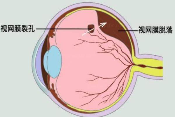 视网膜手术后多久视力能复原呢www.jingansicbd.com