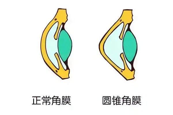 圆锥角膜交联手术多少钱www.jingansicbd.com