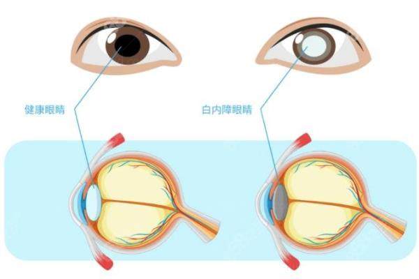 蔡司三焦人工晶体优缺点:优点寿命长适用度数高,缺点价格虚高www.jingansicbd.com.jpg