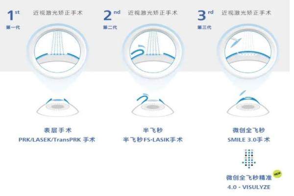 全飞秒4.0手术技术www.jingansicbd.com