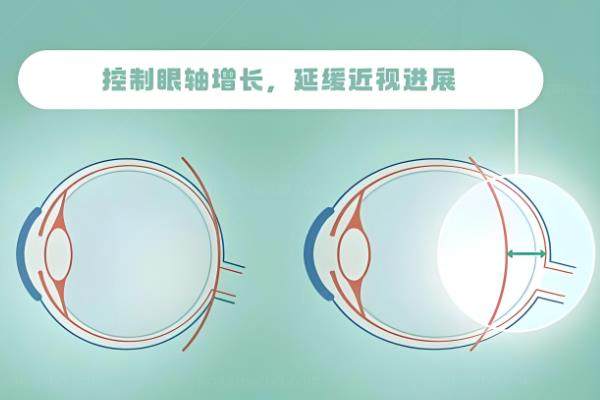 哈尔滨明康视眼科配角膜塑形镜多少钱?CRT11900元/菁视9800元www.jingansicbd.com.jpg