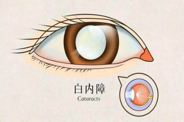 重庆白内障手术免费的吗www.jingansicbd.com