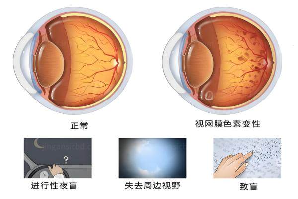 视网膜色素变性现在能治吗?www.jingansicbd.com
