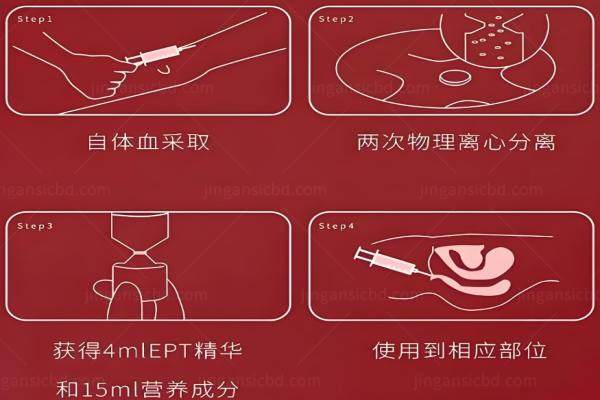 高潮针是什么？yimei.360tulou.com.jpg