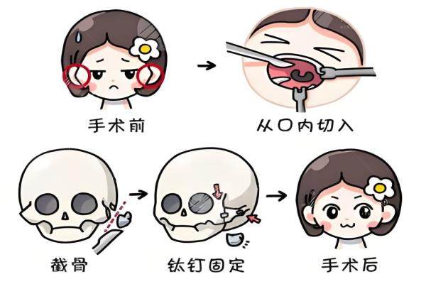 双颚手术是什么手术？yimei.360tulou.com.jpg