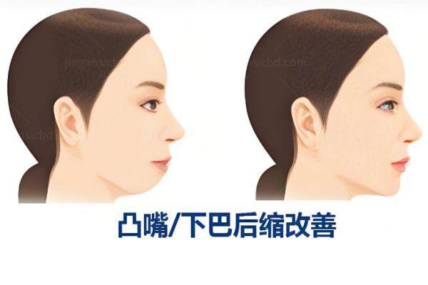 双颚手术是什么手术？yimei.360tulou.com.jpg