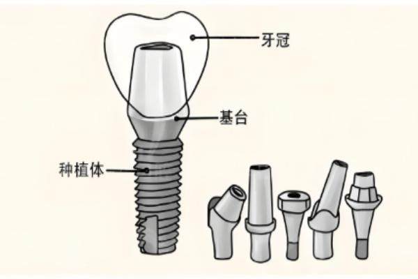 泉州海丝口腔医院种植牙技术怎么样.jpg