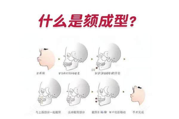 为什么不建议颏成型？揭秘颏成型手术后遗症|危险原因及下巴还会反弹吗？