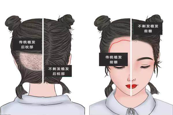 不剃发植发价格|存活率|痛感：30天亲历不剃发植发影响全纪录