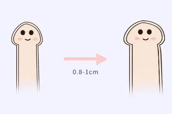 生物补片增粗成功案 例