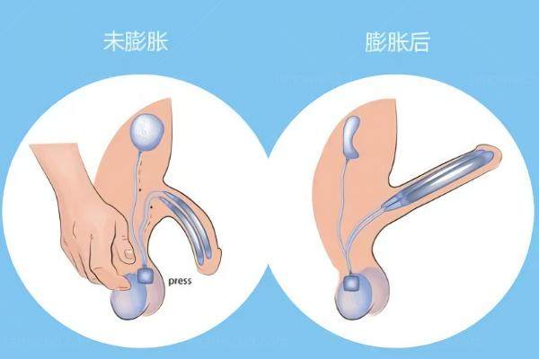 男性假体三件套手术价格