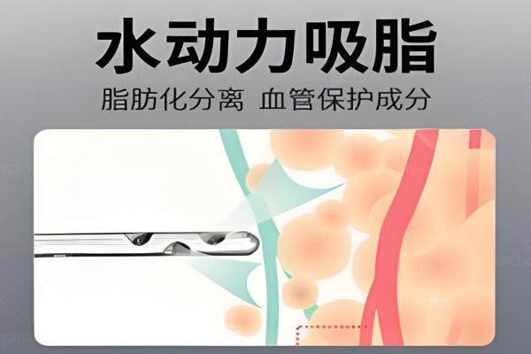 维密脂雕和水动力吸脂.jpg