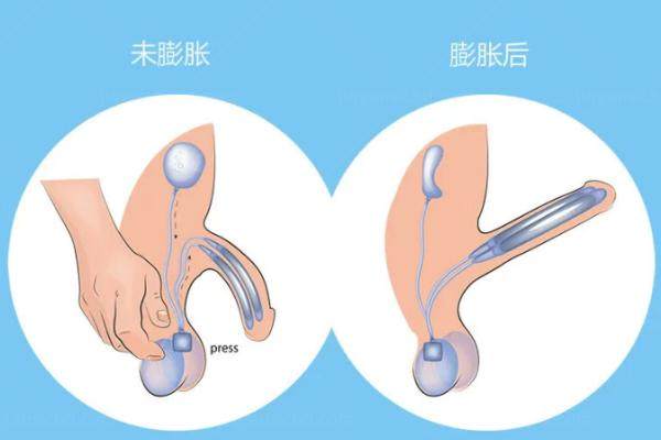 男人假体三件套能用多久？.jpg
