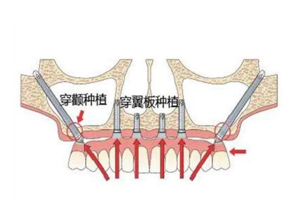 穿颧穿翼种植技术适用人群