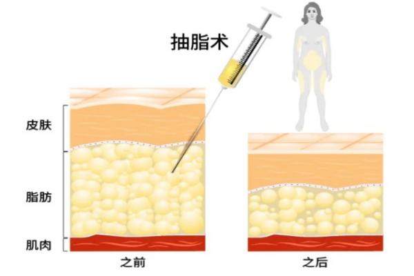 钻石微雕多少钱一个部位