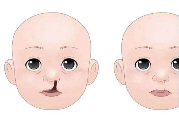 广州做唇腭裂修复哪位医生好