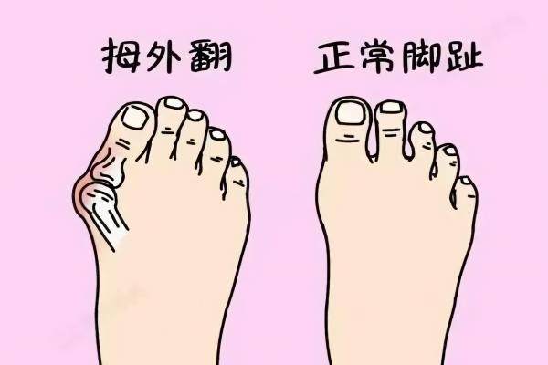 脚拇指外翻手术多少钱
