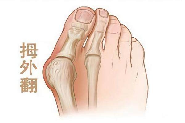 大脚骨手术在哪个医院做好