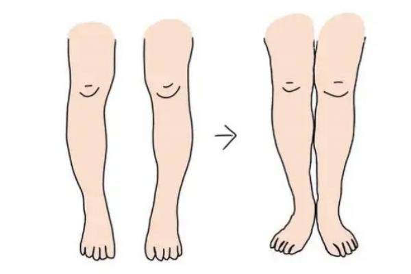 O型腿矫正手术价格表