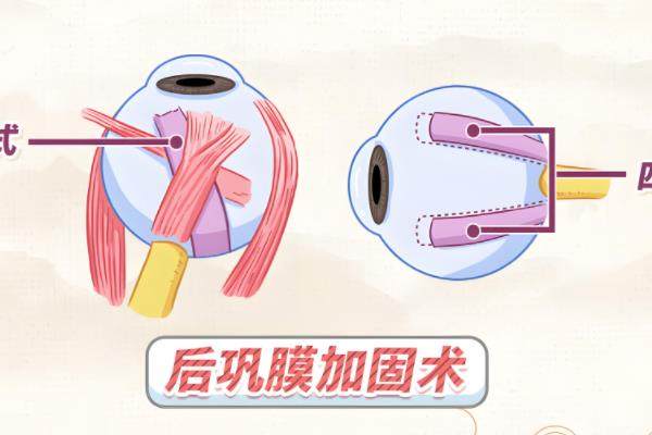 我孩子做了后巩膜加固术,术后三个月视力<span style=