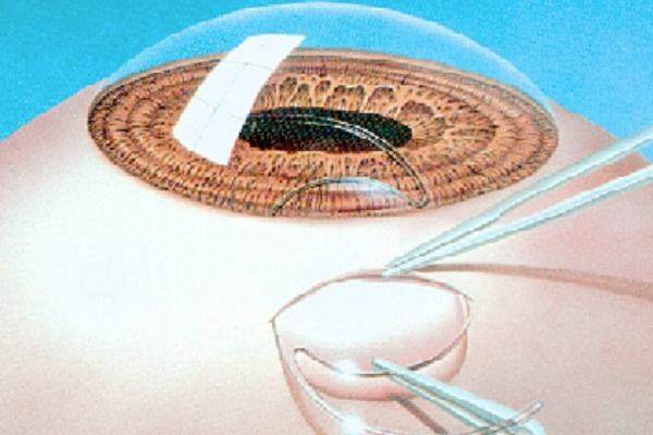 山西白内障手术医院排行榜:临汾洛基/太原普瑞等医院技术好值得推荐