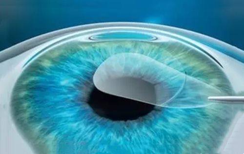 苏州光明眼科医院技术怎么样?很成熟,10年4.2万例手术,全飞秒量苏州前三