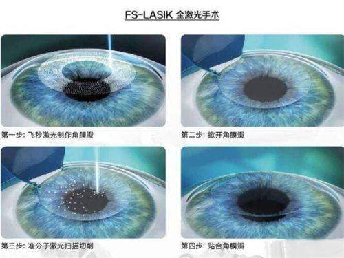 二、苏州光明眼科医院技术成熟吗？