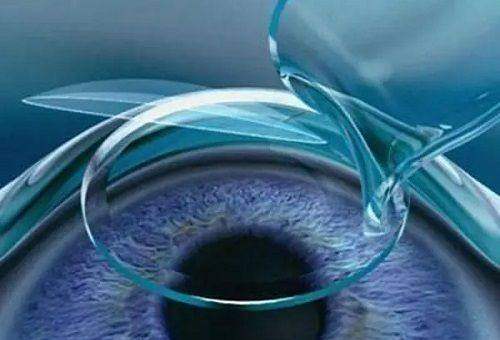 进口人工晶体哪国的好?特整理进口人工晶体品牌排行+收费价格一览!