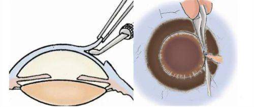 二、漳州华厦眼科医院是正规医院吗？