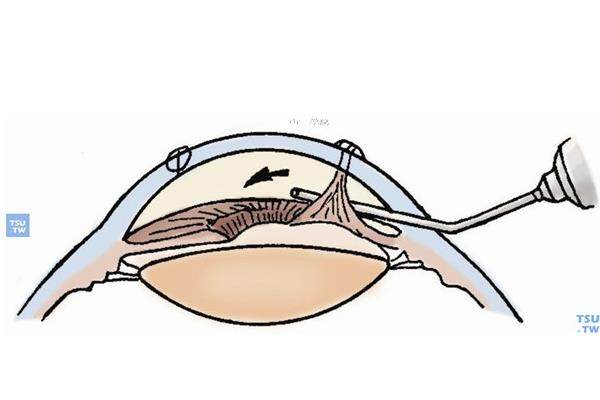 
超薄半飞秒什么意思？是个性化切削矫正屈光不正的方法，与半飞秒区别全解析！