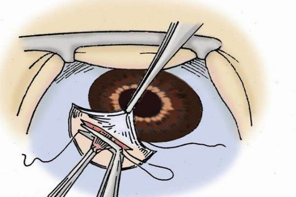 封康和段安丽谁做后巩膜好？需综合考量，看看封康和段安丽做后巩膜手术有什么不同以及谁做后巩膜价格划算